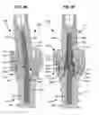 Fig. 28 - LOW PROFILE SPINAL PROSTHESIS INCORPORATING A CANNULATED BONE ANCHOR HAVING A DEFLECTABLE POST AND A COMPOUND SPINAL ROD