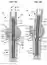 Fig. 45 - LOW PROFILE SPINAL PROSTHESIS INCORPORATING A CANNULATED BONE ANCHOR HAVING A DEFLECTABLE POST AND A COMPOUND SPINAL ROD