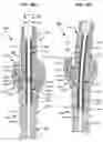 Fig. 47 - LOW PROFILE SPINAL PROSTHESIS INCORPORATING A CANNULATED BONE ANCHOR HAVING A DEFLECTABLE POST AND A COMPOUND SPINAL ROD