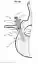 Fig. 10 - LOW PROFILE SPINAL PROSTHESIS INCORPORATING A CANNULATED BONE ANCHOR HAVING A DEFLECTABLE POST AND A COMPOUND SPINAL ROD