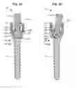 Fig. 12 - LOW PROFILE SPINAL PROSTHESIS INCORPORATING A CANNULATED BONE ANCHOR HAVING A DEFLECTABLE POST AND A COMPOUND SPINAL ROD