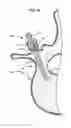 Fig. 13 - LOW PROFILE SPINAL PROSTHESIS INCORPORATING A CANNULATED BONE ANCHOR HAVING A DEFLECTABLE POST AND A COMPOUND SPINAL ROD
