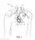 Fig. 02 - IMPLANTABLE LEAD INCLUDING A SPARK GAP TO REDUCE HEATING IN MRI ENVIRONMENTS