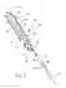 Fig. 04 - Removable stent-graft