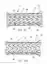 Fig. 06 - Removable stent-graft