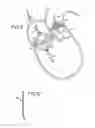 Fig. 05 - Prosthetic valve for transluminal delivery