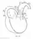 Fig. 14 - Prosthetic valve for transluminal delivery