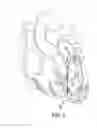 Fig. 04 - Heart valve implant