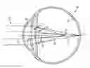 Fig. 01 - Multifocal lens having an optical add power progression, and a system and method of providing same