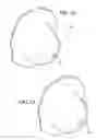 Fig. 12 - Breast and nipple implant constructions