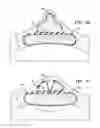 Fig. 19 - Breast and nipple implant constructions
