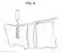 Fig. 07 - Intervertebral ligament having a helical bone fastener