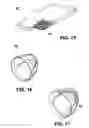 Fig. 11 - SHAPED LOAD-BEARING OSTEOIMPLANT AND METHODS OF MAKING THE SAME
