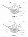Fig. 04 - REPLACEMENT OR SUPPLEMENTATION OF A NUCLEUS PULPOSUS USING A HYDROGEL