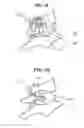 Fig. 06 - Methods and devices for expanding a spinal canal