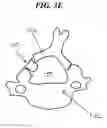 Fig. 07 - Methods and devices for expanding a spinal canal