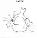 Fig. 08 - Methods and devices for expanding a spinal canal