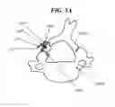 Fig. 10 - Methods and devices for expanding a spinal canal