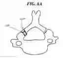 Fig. 13 - Methods and devices for expanding a spinal canal