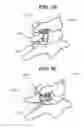 Fig. 14 - Methods and devices for expanding a spinal canal