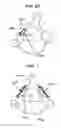 Fig. 15 - Methods and devices for expanding a spinal canal