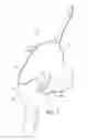 Fig. 04 - HAT FOR DISCRETE AREA APPLICATION OF HEAT OR COLD