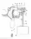 Fig. 05 - PHONATION ASSISTANCE DEVICE FOR A TRACHEOTOMY PATIENT
