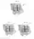 Fig. 03 - Personal care implement with low active cleansing composition
