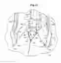 Fig. 15 - MECHANICAL METHOD AND APPARATUS FOR BILATERAL TISSUE FASTENING