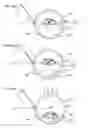 Fig. 33 - Translating multifocal eyeglass lenses