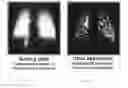 Fig. 04 - Method of treating pulmonary disease with interferons