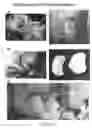 Fig. 02 - Joint Repair Using Mesenchymal Stem Cells