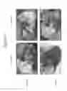 Fig. 07 - Joint Repair Using Mesenchymal Stem Cells