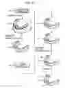 Fig. 13 - ORTHODONTIC APPLIANCE