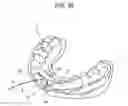 Fig. 34 - ORTHODONTIC APPLIANCE