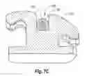 Fig. 08 - Low Force Orthodontic Arch Wire Having Blocks for Improved Treatment