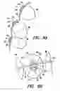 Fig. 04 - Orthodontic brace system and method
