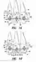 Fig. 05 - Orthodontic brace system and method