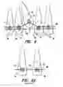 Fig. 06 - Orthodontic brace system and method