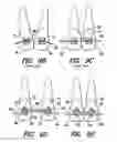 Fig. 07 - Orthodontic brace system and method