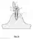 Fig. 16 - Oral implant placement system and method