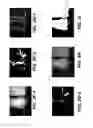 Fig. 04 - Method for identification of dental caries in polychromatic images