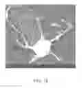 Fig. 11 - Nerve graft