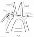 Fig. 03 - Ventricular assist device