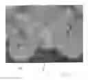 Fig. 07 - Implantable devices for the treatment of incontinence and methods of using same