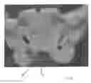 Fig. 08 - Implantable devices for the treatment of incontinence and methods of using same