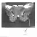 Fig. 09 - Implantable devices for the treatment of incontinence and methods of using same