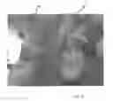 Fig. 15 - Implantable devices for the treatment of incontinence and methods of using same
