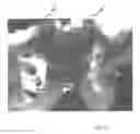 Fig. 17 - Implantable devices for the treatment of incontinence and methods of using same