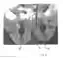Fig. 18 - Implantable devices for the treatment of incontinence and methods of using same